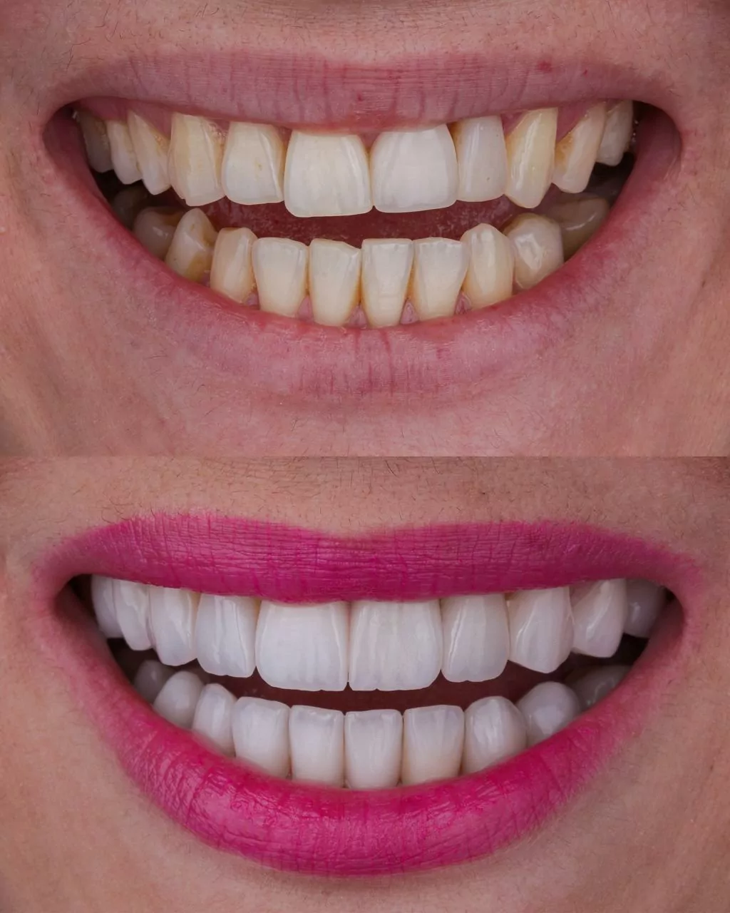 lentes-de-contato-dental-orlando-florida-rio-dental-art