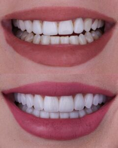 lentes-de-contato-dental-orlando-florida-rio-dental-art