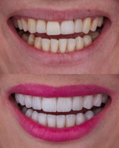 lentes-de-contato-dental-orlando-florida-rio-dental-art