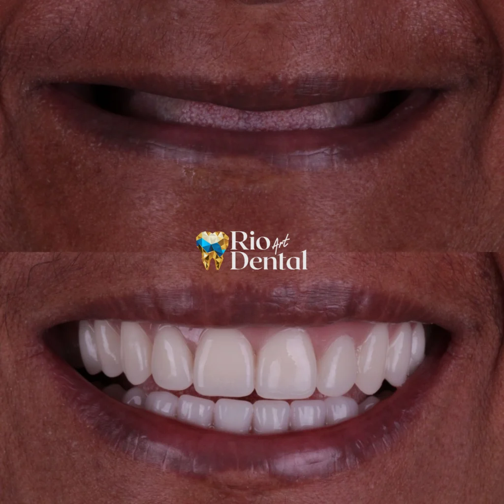 Dentista em Orlando - Implante Dentário em Orlando - Rio Dental Art