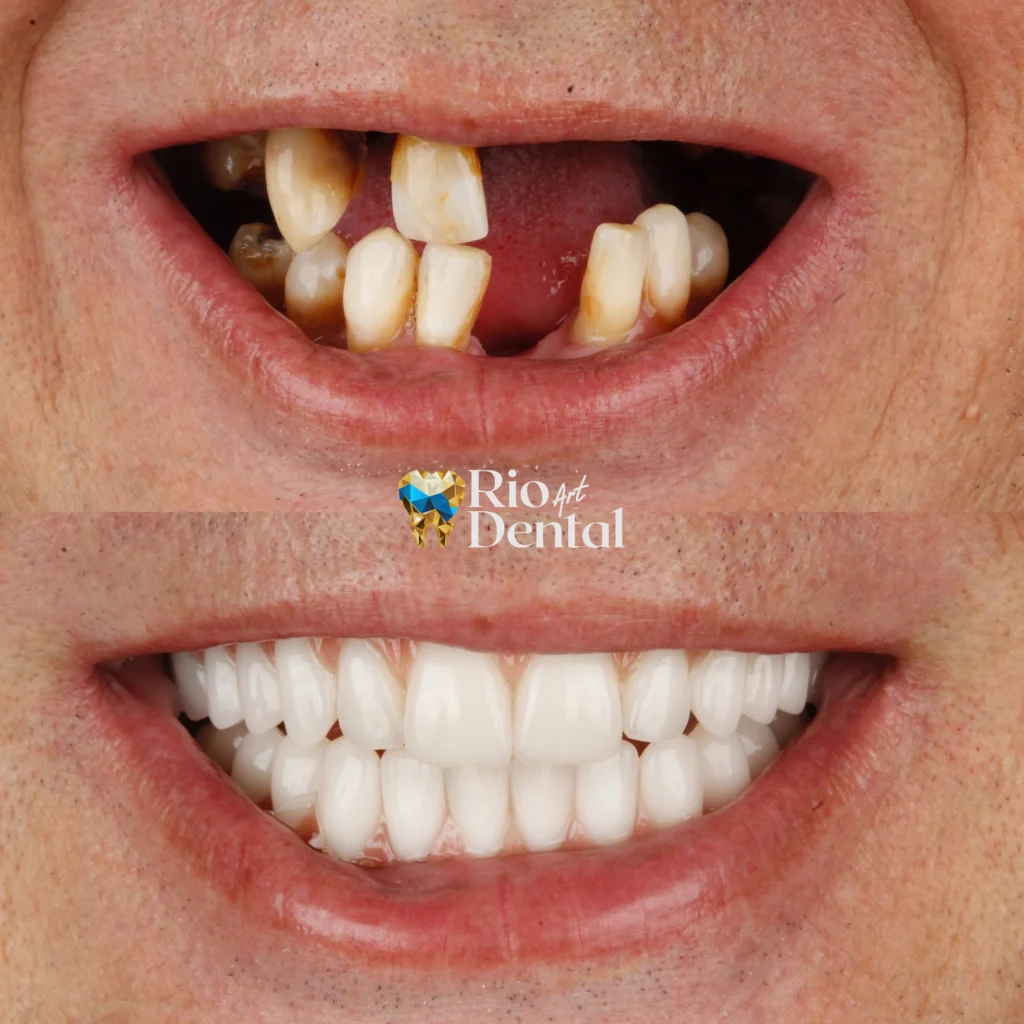Dentista em Orlando - Implante Dentário em Orlando - Rio Dental Art
