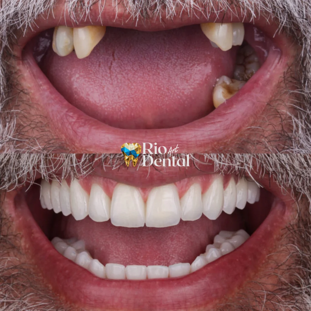 Dentista em Orlando - Implante Dentário em Orlando - Rio Dental Art