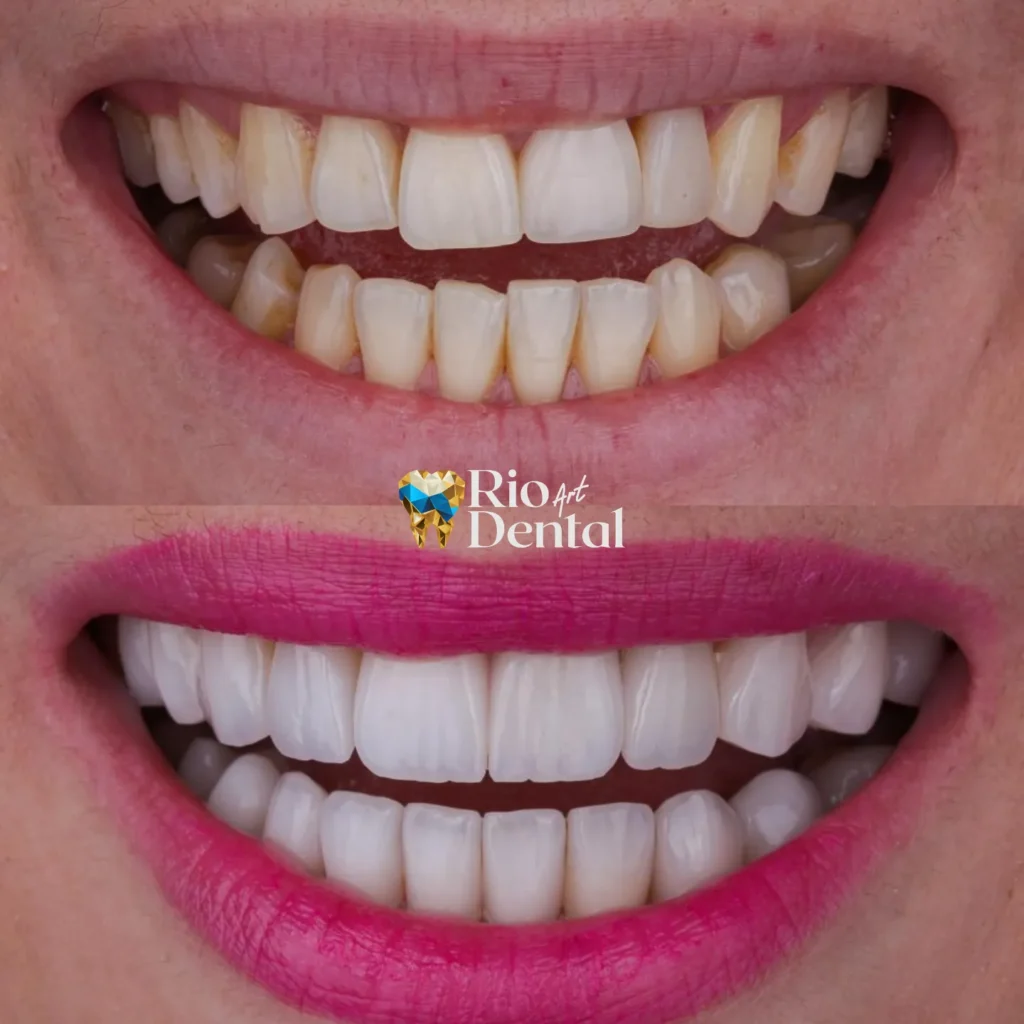 Dentista em Orlando - Lentes de contato dental porcelana em Orlando - Rio Dental Art