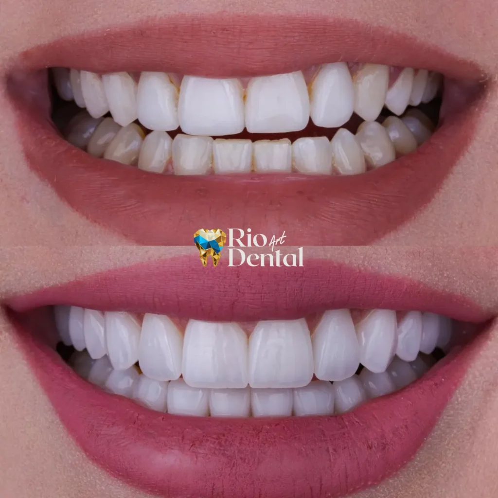 Dentista em Orlando - Lentes de contato dental porcelana em Orlando - Rio Dental Art