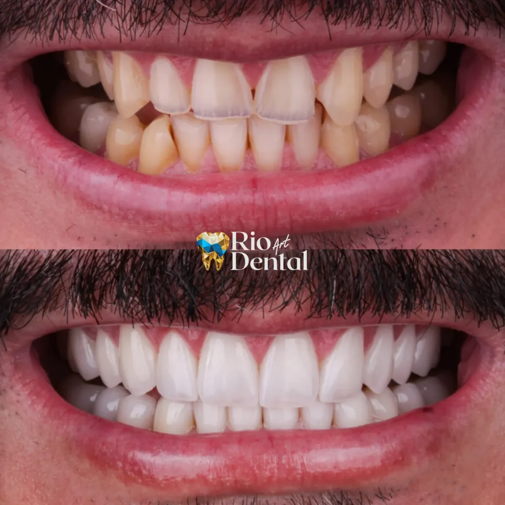 Dentista em Orlando - Lentes de contato dental porcelana em Orlando - Rio Dental Art