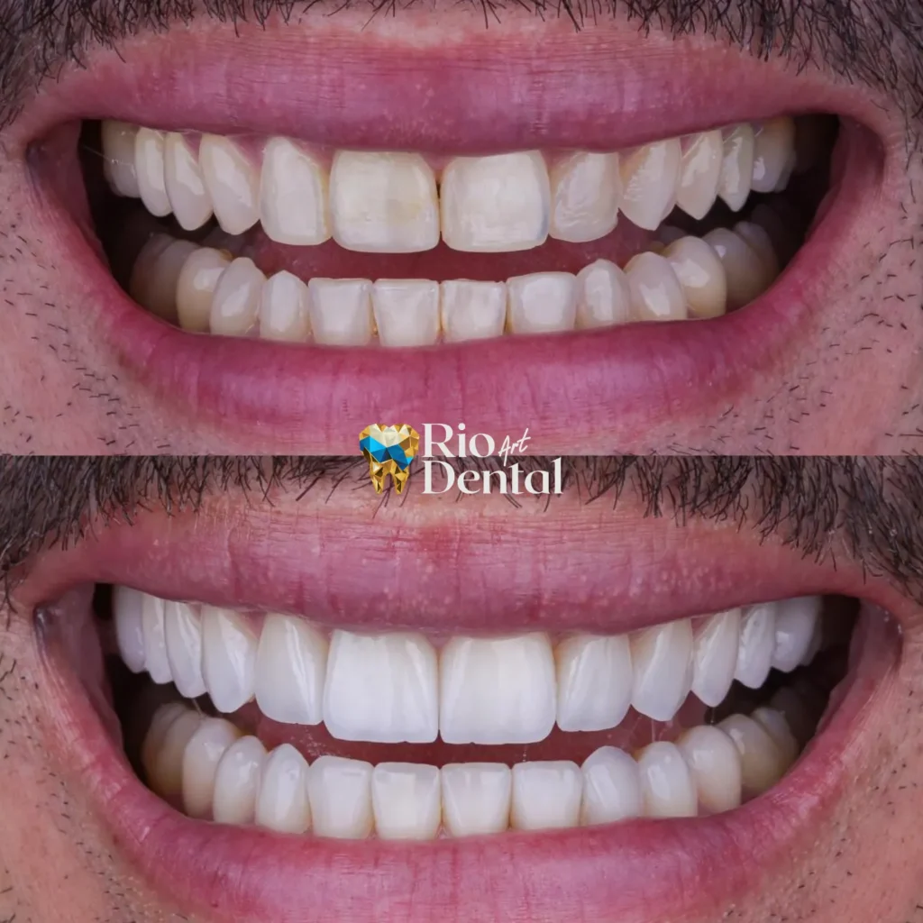 Dentista em Orlando - Lentes de contato dental porcelana em Orlando - Rio Dental Art