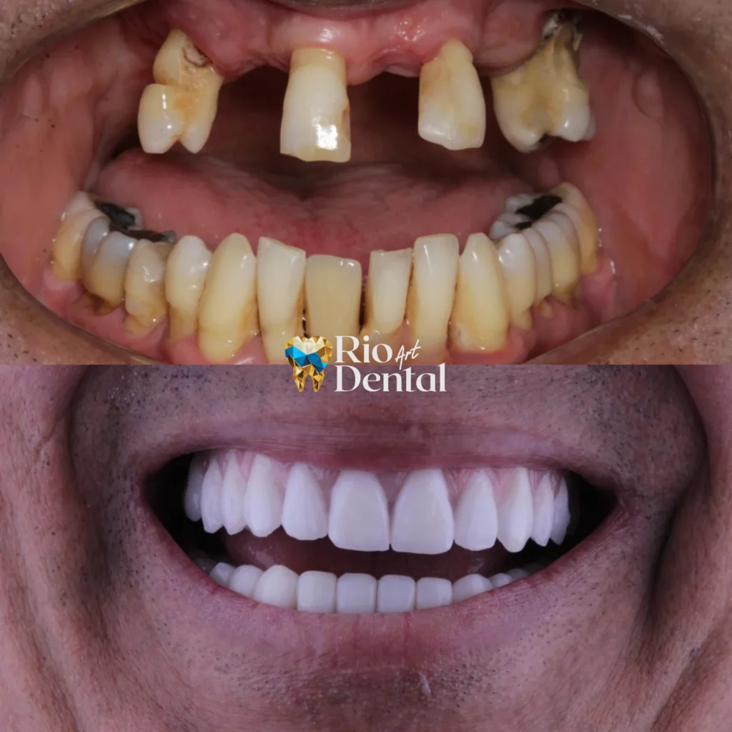 Dentista em Orlando - Implante Dentário em Orlando - Rio Dental Art
